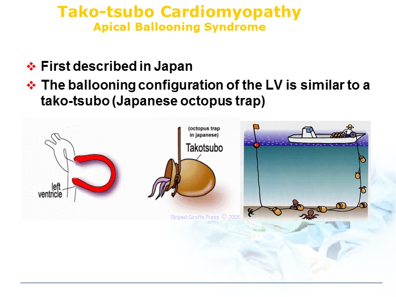 Tako-tsubo Cardiomyopathy Apical Ballooning Syndrome First described in Japan  The ballooning configuration of